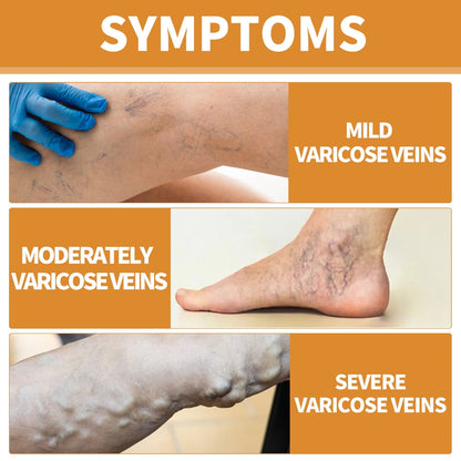Turmeric Varicose Vein Relief Spray( BUY 1 GET 2 FREE💥 🎁  )