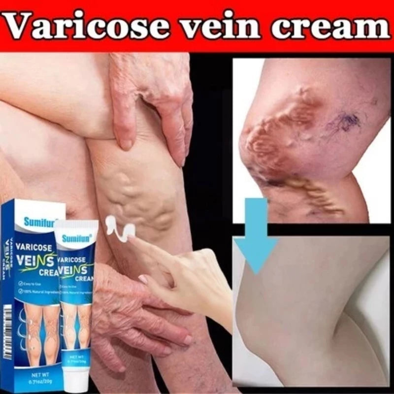 Sol Lora Varicose veins Cream (BUY 1 GET 1 FREE)